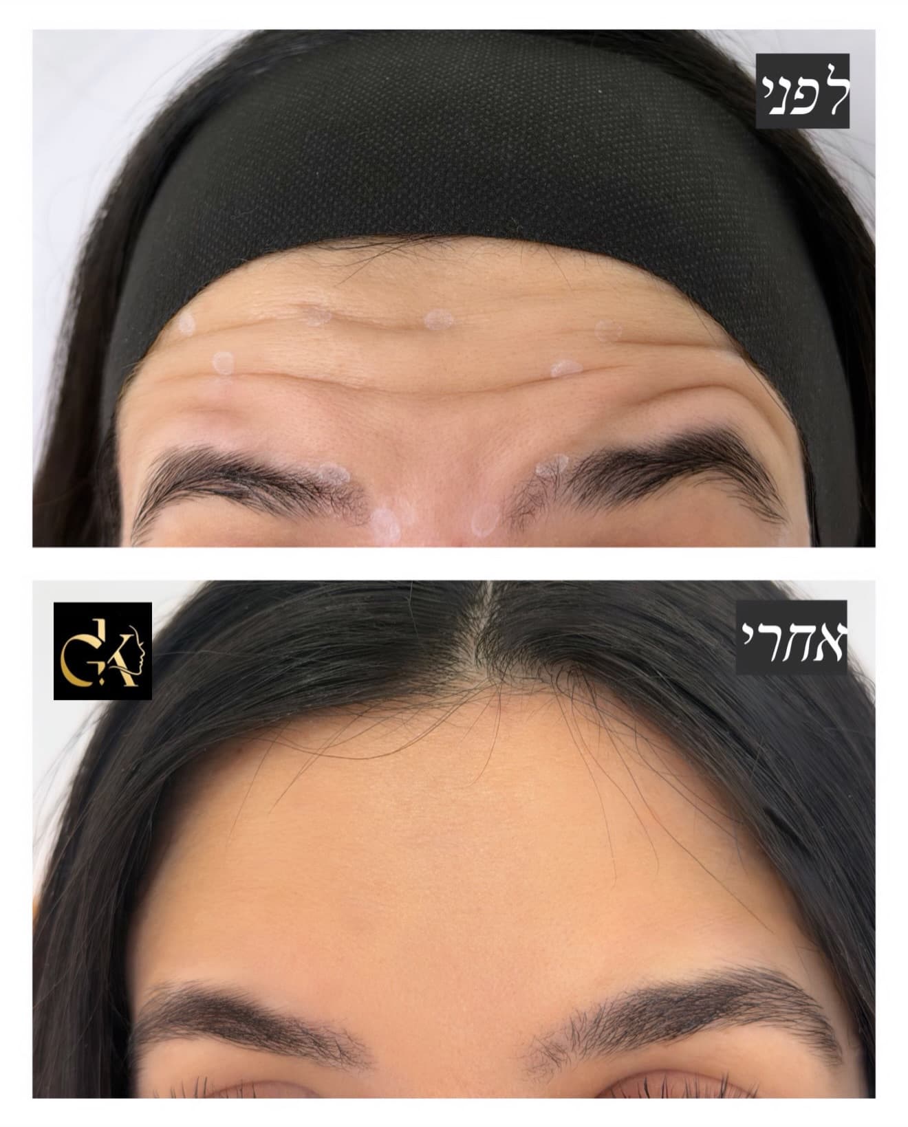 קמטי הבעה במצח לפני ואחרי